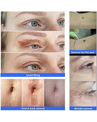 Dərinin möhkəmlənməsi üçün cihaz firming_001