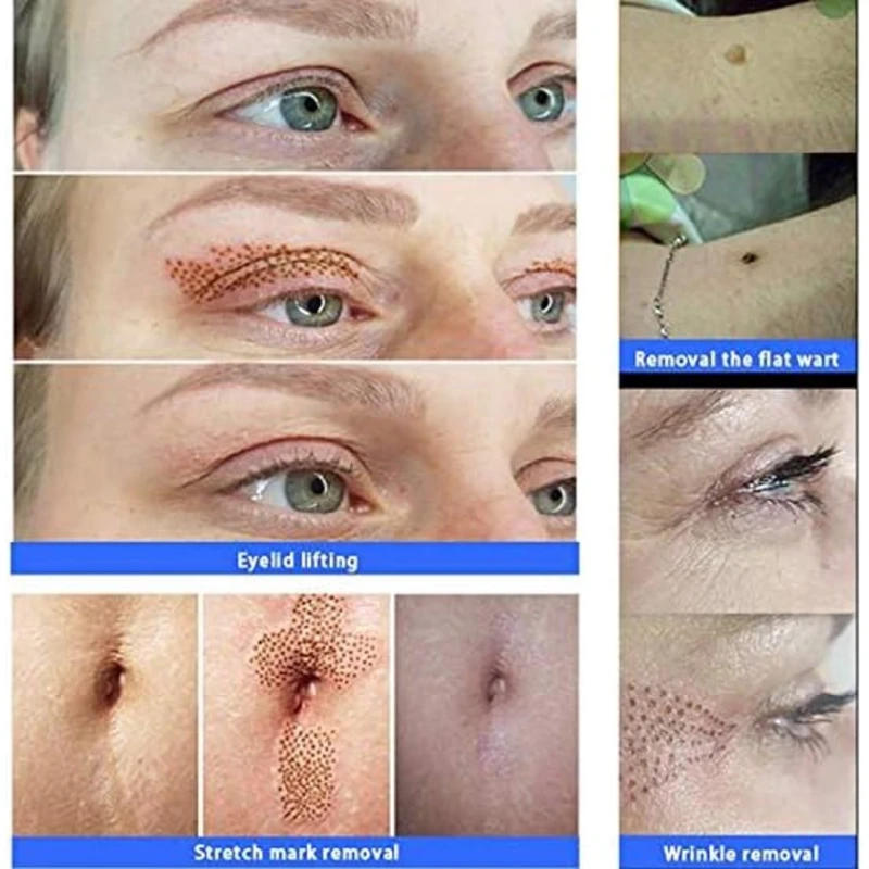 Dərinin möhkəmlənməsi üçün cihaz firming_001