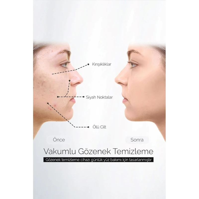 Вакуумный очиститель пор Dempower Dp-09 Вакуумный очиститель пор Dempower Dp-09